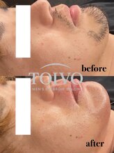 トイヴォ(TOIVO)/顔脱毛ビフォーアフター！