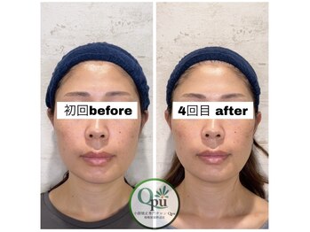 キュープ 相模原淵野辺店(Qpu)/たった4回で人生で1番小さな顔に