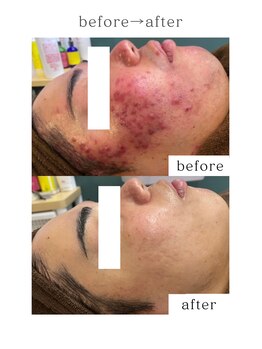 女神デトックス 長野店の写真/【肌質改善】繰り返すニキビ・跡に◎ダウンタイム無し！剥離無しで敏感肌の方や予定前でもOK◎