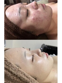 クレヴィー(Creviy)/ハーブ＋スキンケアのみで