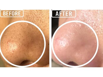 毛穴屋/毛穴洗浄後