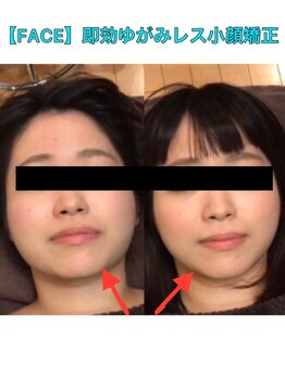 フォルム ボディアンドフェイス 恵比寿(Forme)/フェイスライン一度で激変します