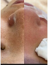 ラデュープラス(Radieux+)/【韓国式３D毛穴洗浄】前後