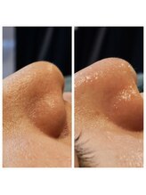 ラデュープラス(Radieux+)/韓国式3D毛穴洗浄