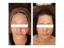 ビーチェ(BICE)/ホワイトハーブピーリング4回目