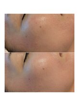 イロドリ(irodori)/DOCスキンケア使用2カ月の変化♪