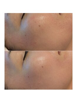 イロドリ(irodori)/DOCスキンケア使用2カ月の変化♪