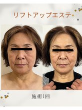 コリオ(KoRiO)/切らないリフトアップエステ