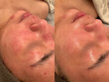 ポーデベロア(Peau des velours)/陶肌トリートメントビフォアフ