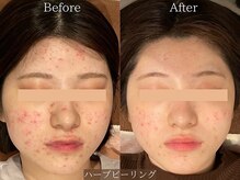 ライフサロン 天神(Life Salon)の雰囲気（繰り返すニキビケア◎お顔ハーブピーリング☆Before /After）