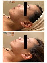 エイシスグロウ(asis glow.)/効果写真