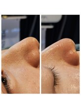 ラデュープラス(Radieux+)/韓国式3D毛穴洗浄