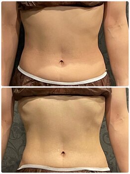 ソルエユニーク(Le seul et unique)/余分なお肉をゴッソリカット。