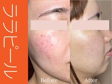 ビューティーリバース 東戸塚店/ララピール50分