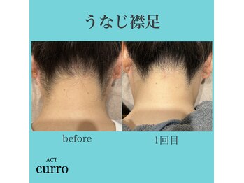 アクト クロ(ACT curro)/【うなじ襟足】脱毛施術例