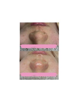 毛穴ケアをしたい