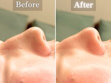 ボーンオム(Born Homme)/毛穴洗浄＋美容液導入：20代女性