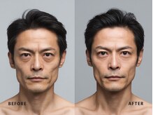 ミネルバ(MINERVA)/施術例 50代男性　フェイシャル