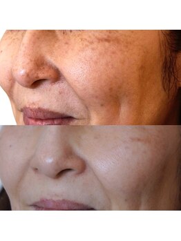 トラット エステアンドアイズ(tratto)/50代お客様症例写真