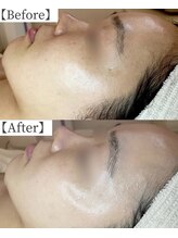 ゴールド 栄店(GOLD)/毛穴洗浄＋水光美肌ケア ５回後