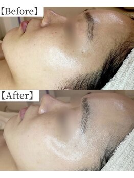 ゴールド 栄店(GOLD)/毛穴洗浄＋水光美肌ケア ５回後