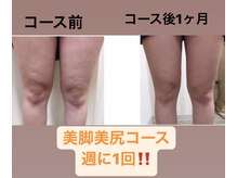 リュミエール(Lumiere)/【症例】下半身太リコース