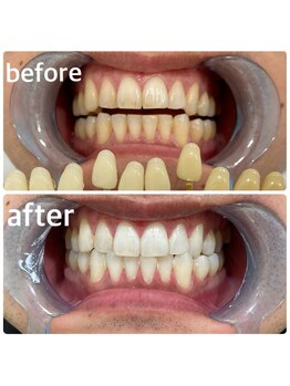 エクシアホワイトニング 日本橋店/ビフォアフ