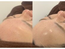 アイプラス ニコ(eye+ nico)/ララピール