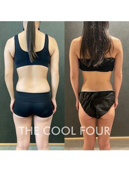 クライオ360(Cryo360)/脂肪冷却ビフォーアフター