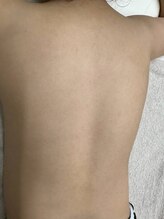 ブルーココア(BlueCocoa)/キッズ脱毛背中6回目