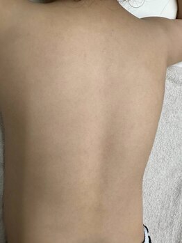 ブルーココア(BlueCocoa)/キッズ脱毛背中6回目