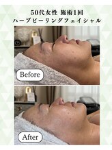 シーフェイス 横浜店(SEE FACE)/ハーブピーリングハリツヤアップ