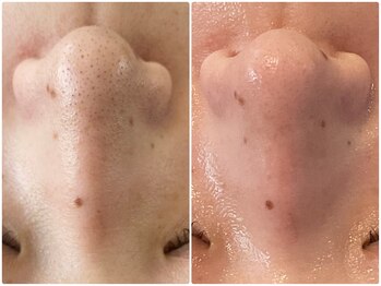 ルミエール フォレストサイド(L’MIERE forestside)/長年の毛穴の黒ずみ改善