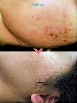 ケイカ(KEIKA)/『にきびケア毛穴ケア』3,300円