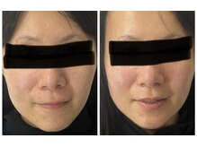 ポマイカイ 名古屋丸の内店(pomaikai)/ハイドロフェイシャル