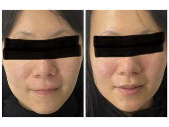 ポマイカイ 名古屋丸の内店(pomaikai)/ハイドロフェイシャル