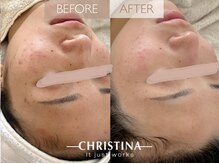 サロンブランシュ(salon BLANCHE)/ハーブピーリングでデトックス◎