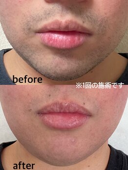 プロッソル こころ(PROSOL)/3/1から脱毛始まります！！