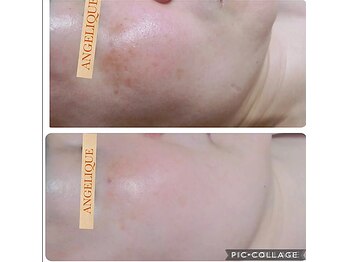 アンジェリーク/シミケア実績15年BA多数