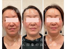 【小顔矯正・整顔】歪み・左右差改善!口角UP!驚きの変化あり◎