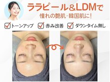 アンドミー 福岡博多店(&me)の雰囲気(今話題ララピール◎【ハーブピーリング/ニキビケア/毛穴洗浄】)