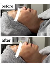 サロン ド ビューティフルール(Salon de beaute Fleur)/衝撃のリフトアップ?!