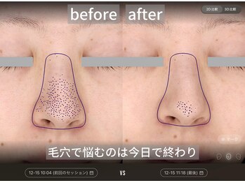 ダイヤモンドトゥルース(Diamond truth)/この結果が毛穴ケアの新常識