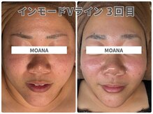 余分な脂肪にアプローチ！魅力的なVラインと横顔美人に♪