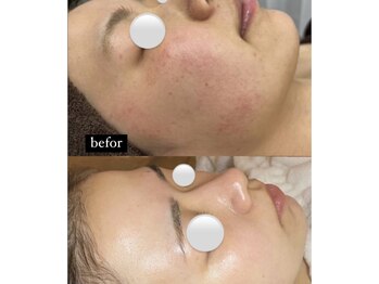 チェルト 鈴鹿店(CERTO)/REVIハーブピーリング毛穴ケア♪