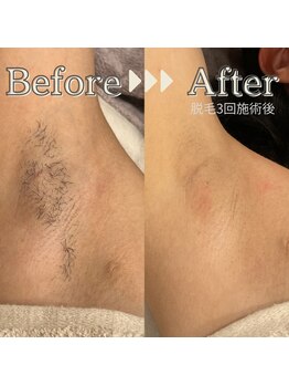 サンスエイジ(Sans age)/脇脱毛 1,320円(税込)