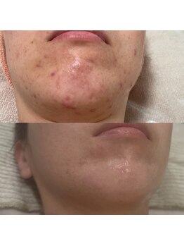 ジャストミービューティー(Just Me Beauty)/肌質改善/毛穴ケア/ニキビケア