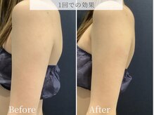 ブリリオ 池袋店(Brillio)/BODY◇lifit部分×ラジオ波