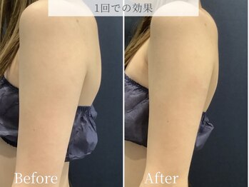 ブリリオ 池袋店(Brillio)/BODY◇lifit部分×ラジオ波