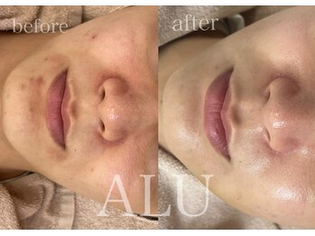 アルフォービューティー 難波店(ALU for beauty)/ニキビ・肌荒れ症例